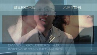 Port-Wine Stain Birthmarks treated by Dr. David Goldberg NY