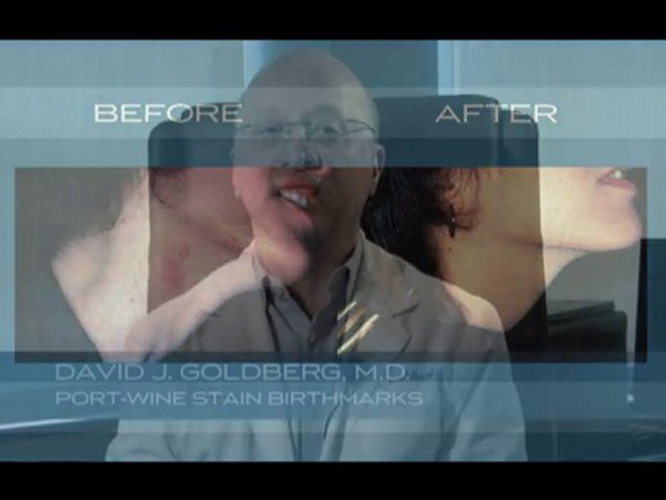 Port-Wine Stain Birthmarks treated by Dr. David Goldberg NY
