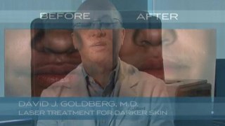 Laser Treatment for darker skin in New York and New Jersey