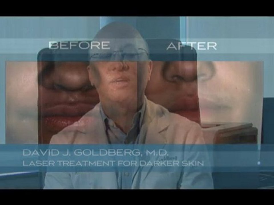 Laser Treatment for darker skin in New York and New Jersey