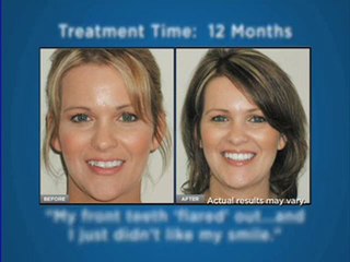 Invisalign Austin, Austin residents Receive a $500 Discount