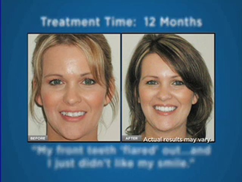 Invisalign Austin, Austin residents Receive a $500 Discount