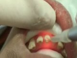 Lazer ile endodontal derin dezenfeksiyon.