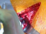 The Anterior Supine Approach to Total Hip Arthroplasty