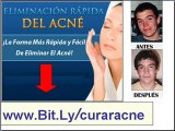 Descubre Como eliminar el acne - Como quitar el acne