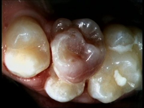 When Children lose their baby teeth visit Dr. Wade Harrouff