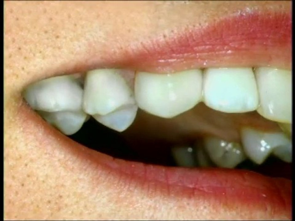 The Bonding & Fillings explained by Dr. Wade Harrouff DDS