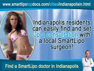 SmartLipo Top Docs Indianapolis