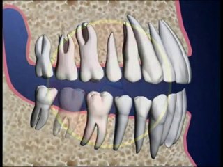Dr. Wade Harrouff answeres Dental Bridge Procedure questions