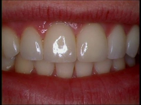 Dear Dr. Harrouff, Why would I ever need Porcelain Crowns?