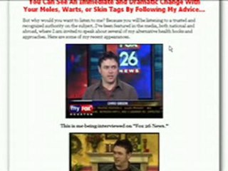 Mole Wart Removal Technique Review - Chris Gibson