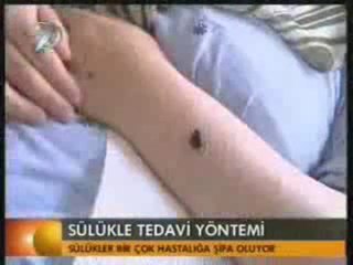 kanal 7 Steril tıbbi sülük haberleri www.sulukler.com