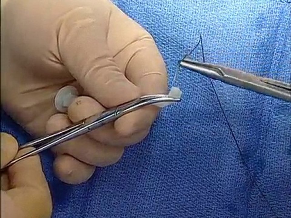 fistula plug