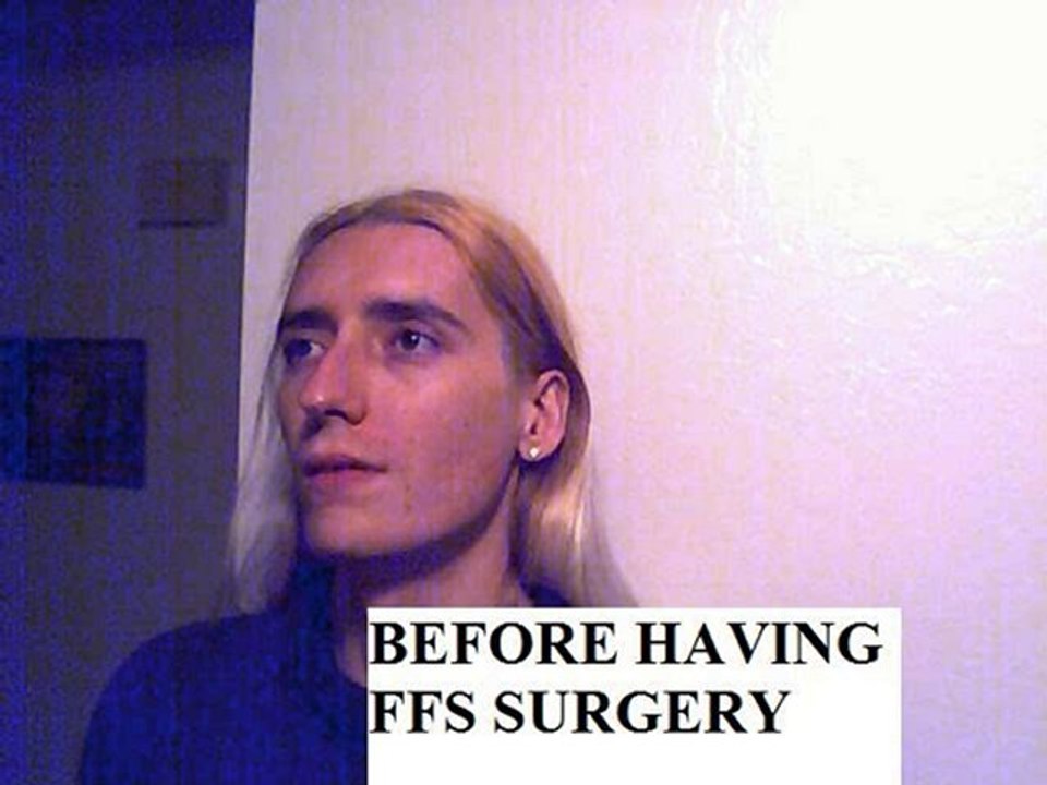 facial feminization surgery ffs with Dr Douglas Ousterhout