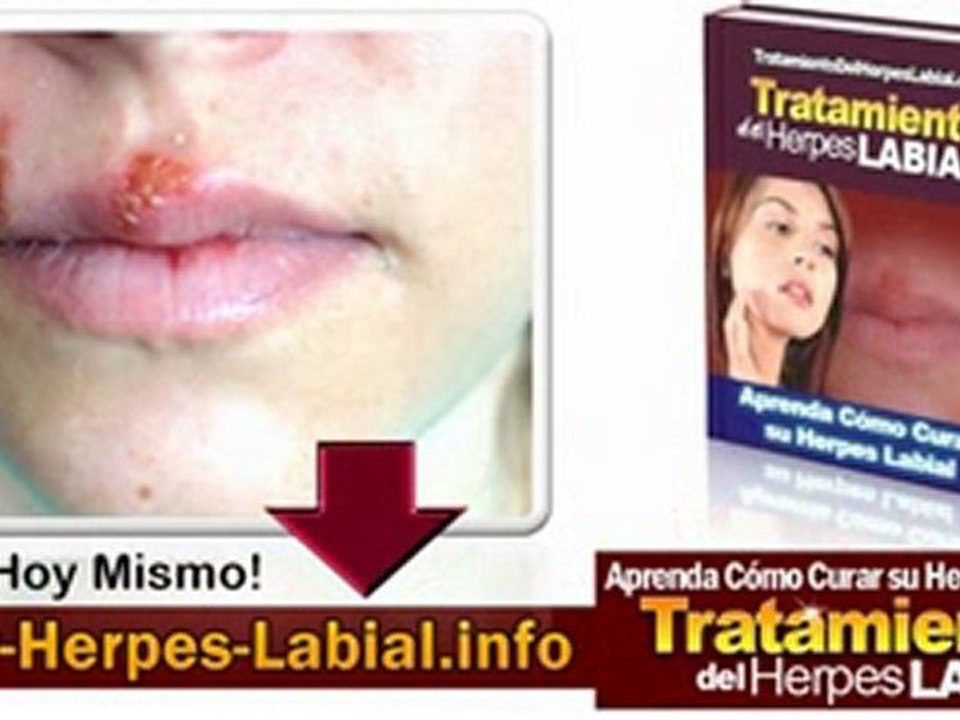 Del Herpes Labial - Tratamiento del Herpes Labial