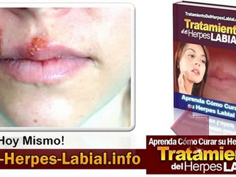 Virus Herpes Labial - Tratamiento del Herpes Labial