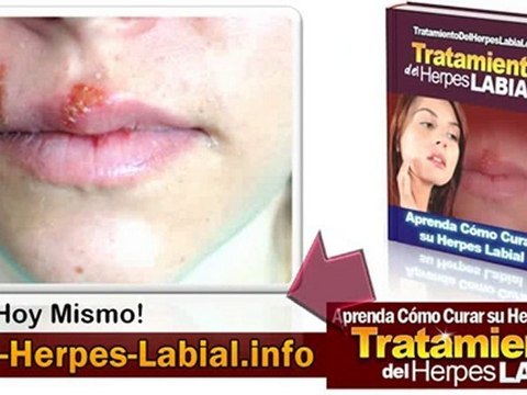 Herpes Simple Tipo1 - Tratamiento del Herpes Labial