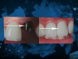 Oxford dentist explains a dental implant procedure