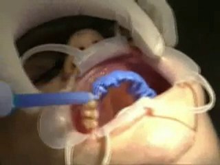 Restoring Youth with Porcelain Veneers Beverly Hills