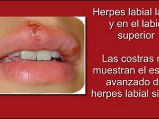 Tratamiento del Herpes Labial Natual Rapido y Sencillo