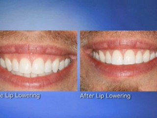 Patient Discusses His Los Angeles Smile Makeover