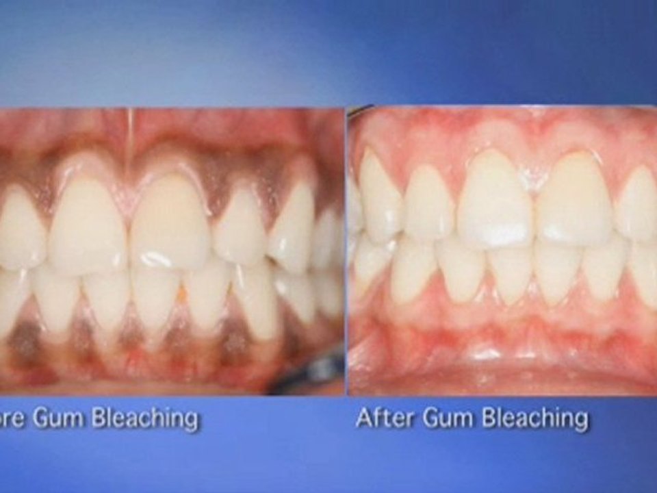 Model Discusses Dark Gums in Beverly Hills