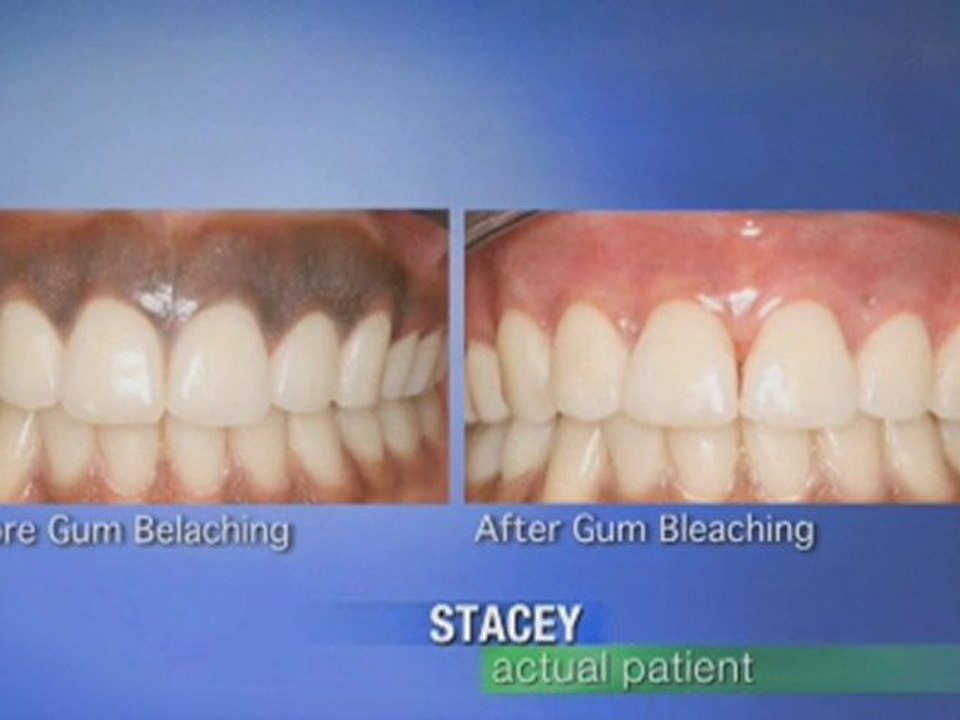 Testimonial  About Treatment for Dark Gums in Los Angeles