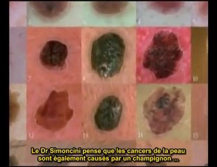 Simoncini sur traitement du cancer par bicarbonate de soude3