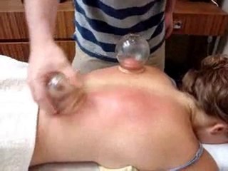 Toronto Cupping Chinese Medicine Treatment