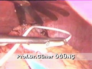 Mide Bandı Ameliyatı (1) Prof. Dr. Güner ÖĞÜNÇ