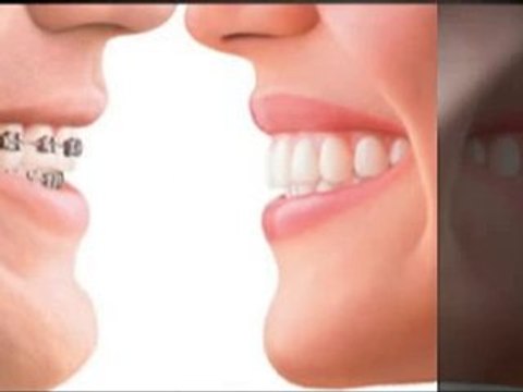Oxford dentists fit veneers transform patients smile