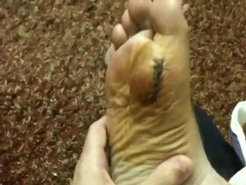 Stitches Stitches Stitches