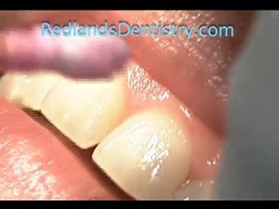 Redlands Dentist Fixes Gummy Smile in Minutes