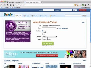 Corrective Jaw Surgery - Before and After