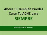 Los Mejores Tratamientos Contra El ACNE
