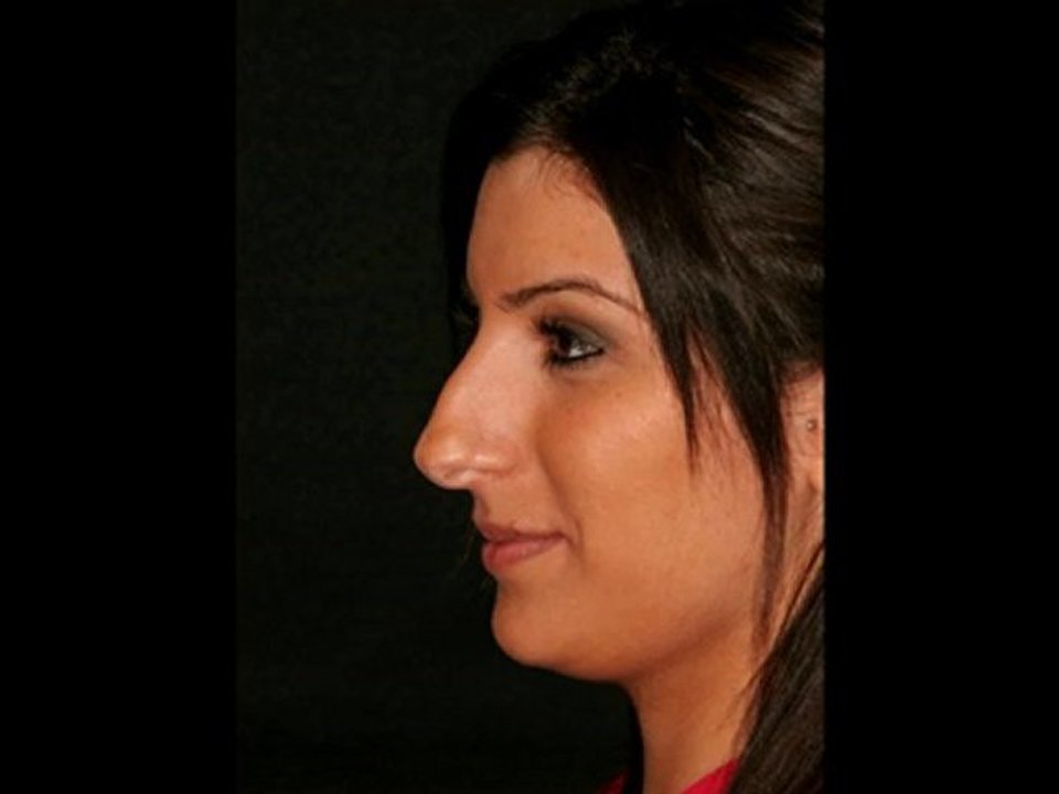 dr. sarigül, nose nase estetik burun berlin lacomed clinic