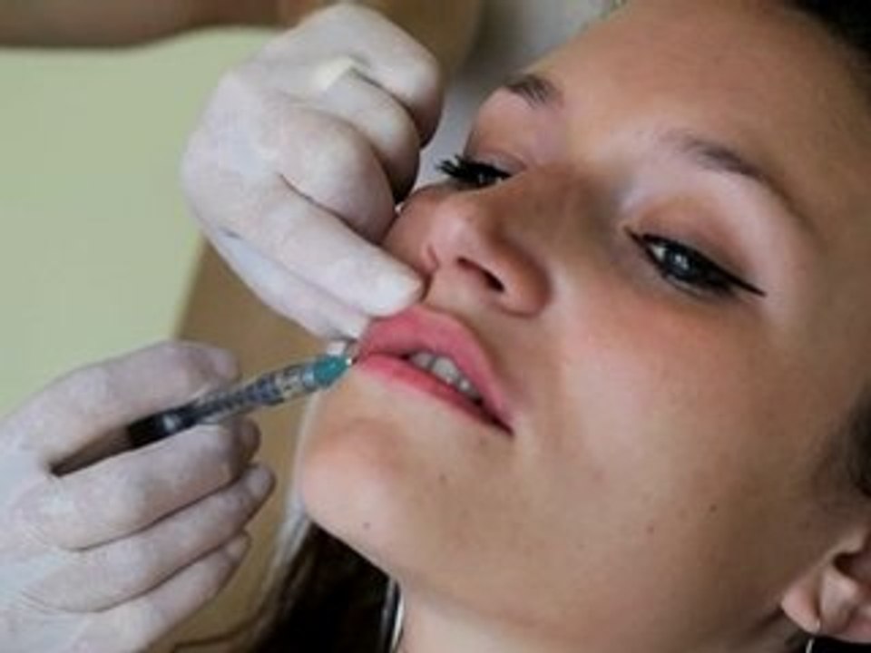 Augmentation de volume de le lèvre par acide hyaluronique
