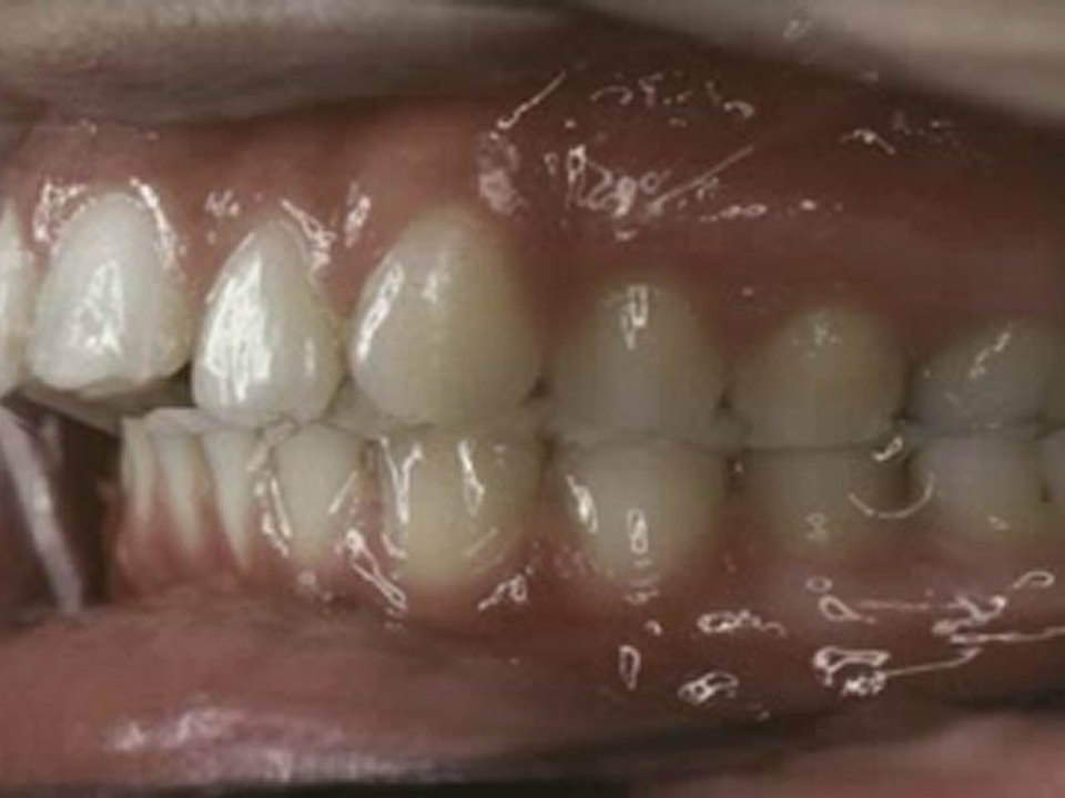 Alt çenenin geride veya üst çenenin önde olması tedavisi