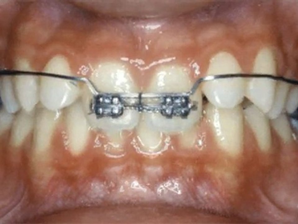 Kesici dişlerin gömülmesi