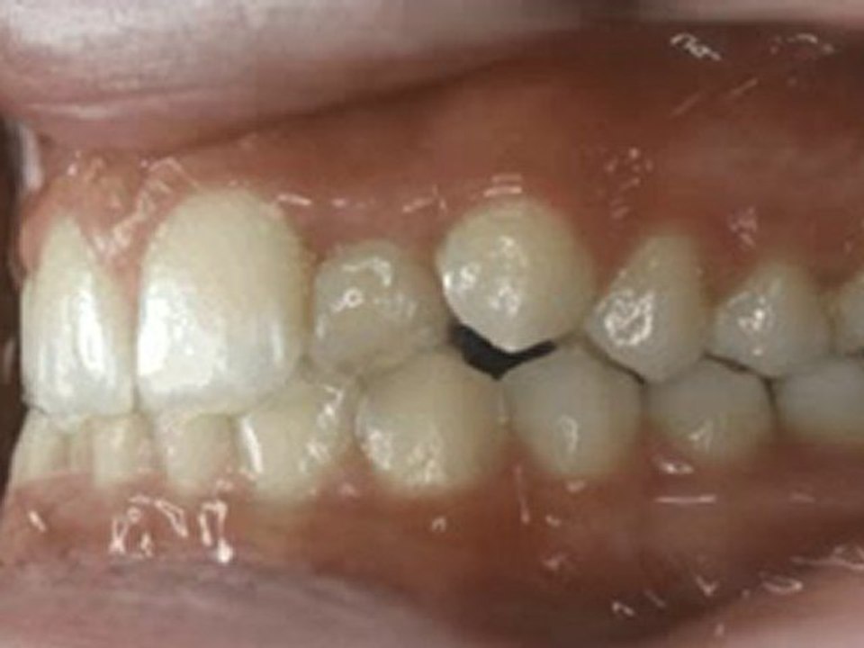 Lateral (yan kesici) diş çapraz kapanışı