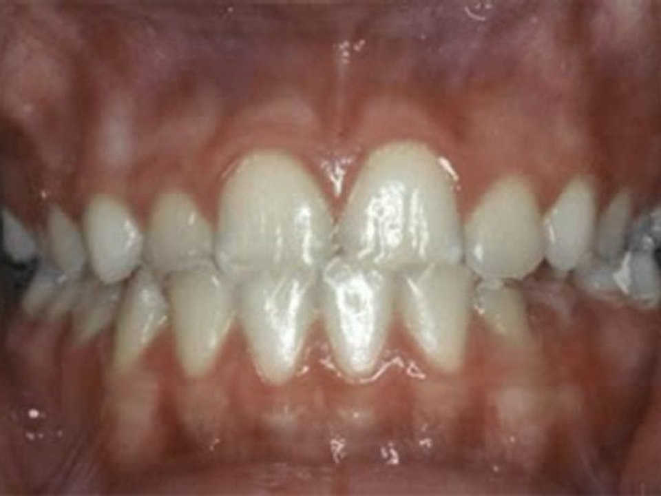 Ön çapraz kapanış