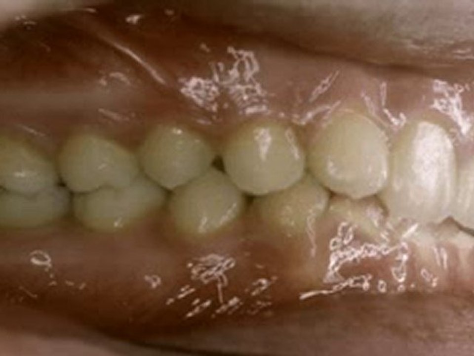 Sınıf 2 Bölüm 2 (derin kapanış) tedavisi