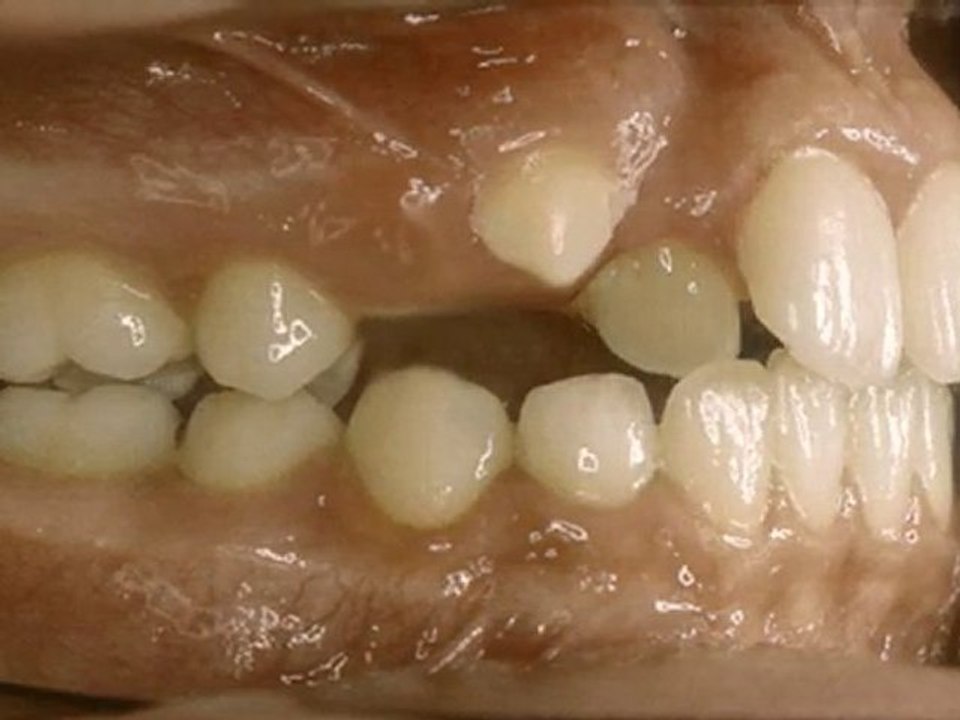 Sürmemiş kaninlerin (köpek dişi) sürdürülmesi