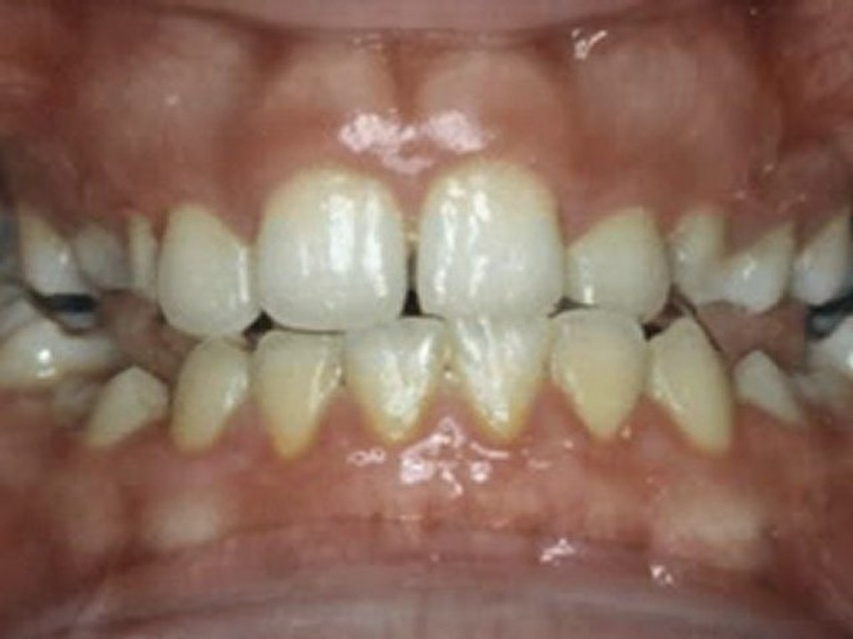 Yan açık kapanış tedavisi