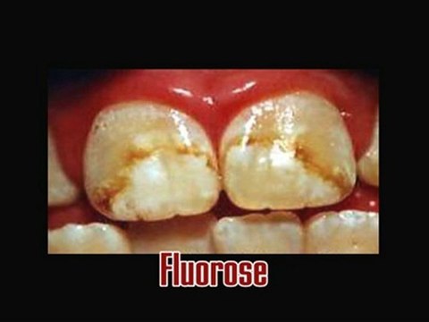 Le Libre Penseur - DANGER FLUOR