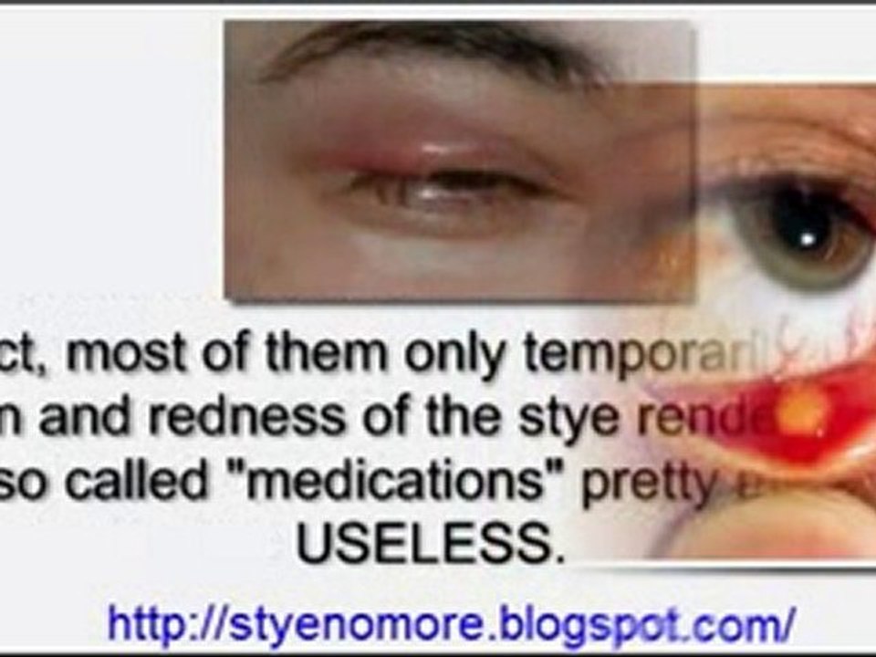 Stye Treatment - Stye No More! Get Rid of Eye Styes Easily