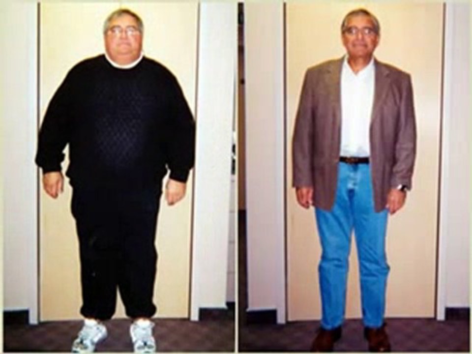 Dallas Bariatric Surgery-Weight Loss Surgery Dallas
