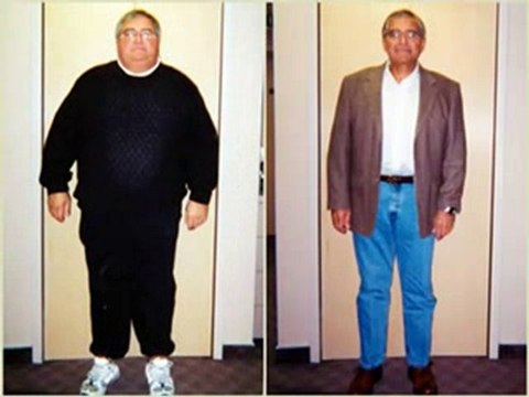 Dallas Bariatric Surgery-Weight Loss Surgery Dallas