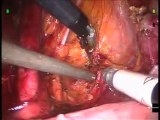 Robotic Radical Hysterectomy --by Dr. Patrick Anderson