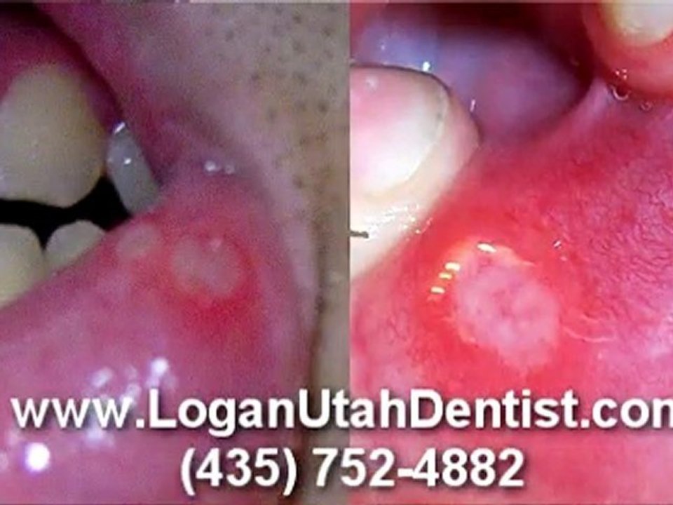 Logan Utah Dentist - Canker Sore